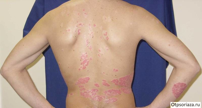 Атипичный псориаз Атипичный псориаз