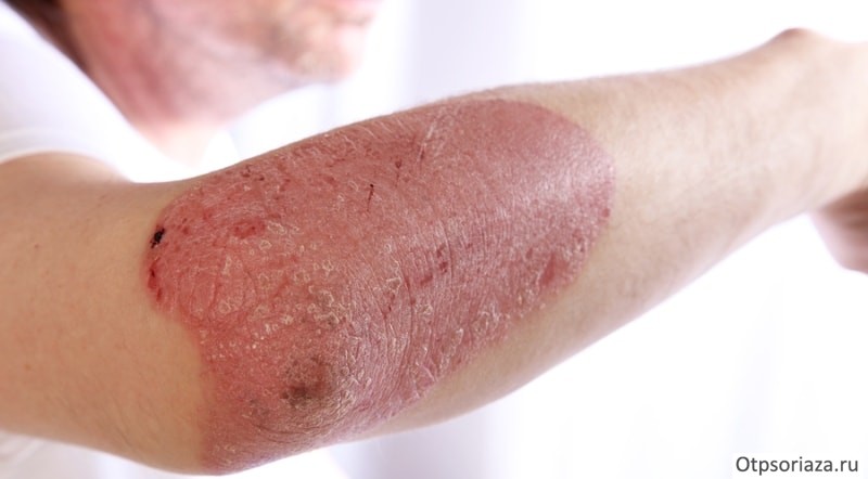 Бляшковидная форма псориаза Бляшковидная форма псориаза
