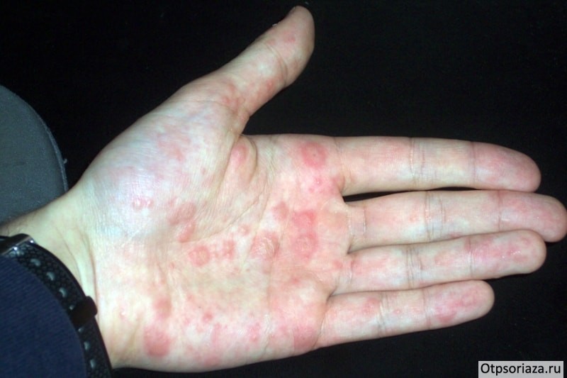 Бляшковидная форма псориаза Бляшковидная форма псориаза