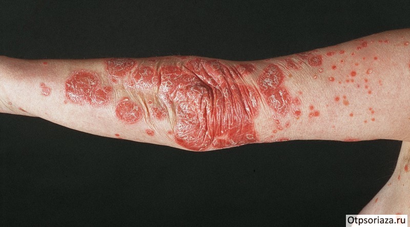 Бляшковидный чешуйчатый лишай Бляшковидный чешуйчатый лишай