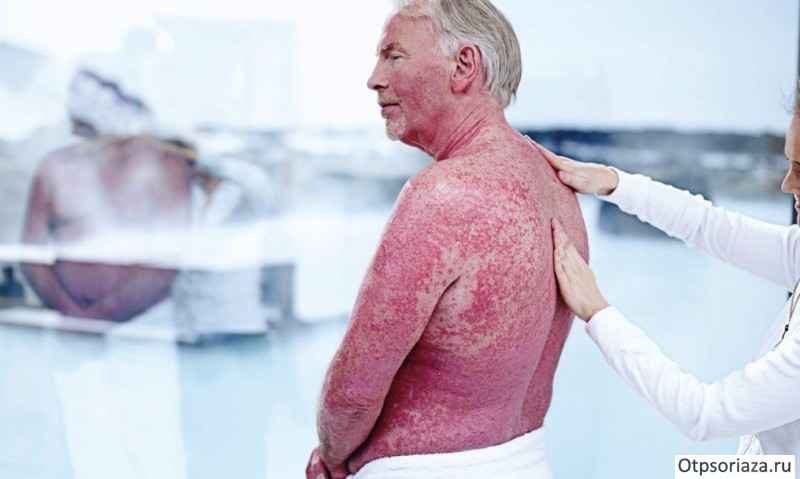 Чешуйчатый лишай Чешуйчатый лишай