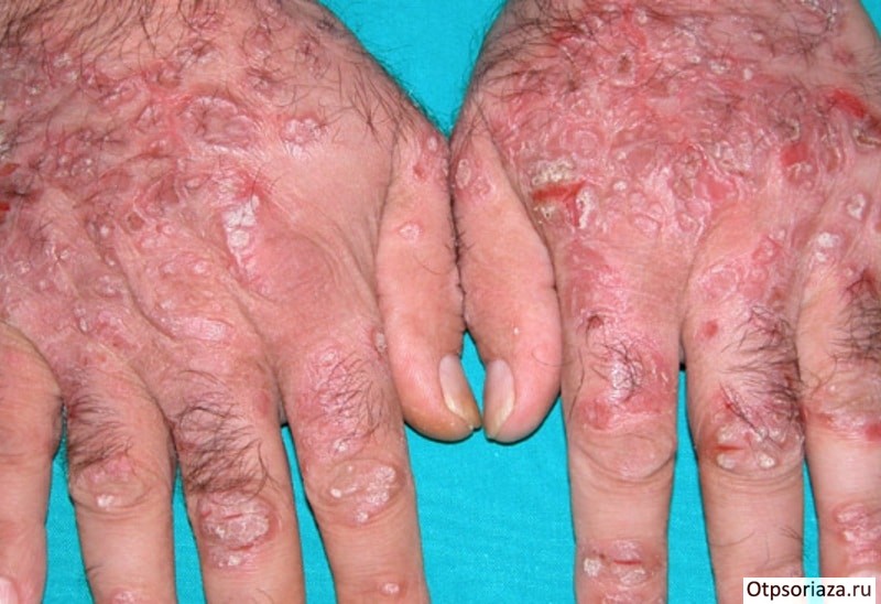 Каплевидная форма псориаза Каплевидный псориаз