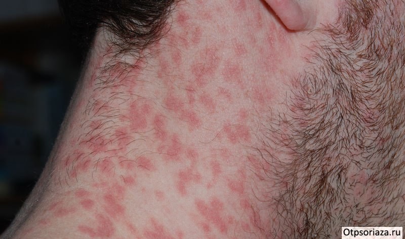 Каплевидный псориаз Каплевидный псориаз