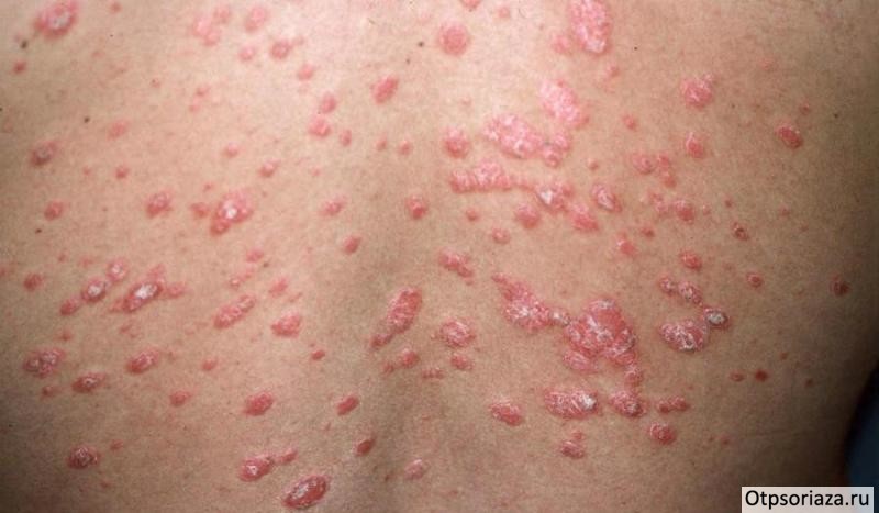 Каплевидный псориаз Каплевидный псориаз