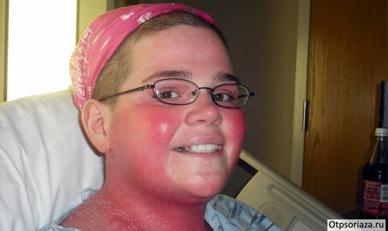 Лицо с псориазом Лицо с псориазом