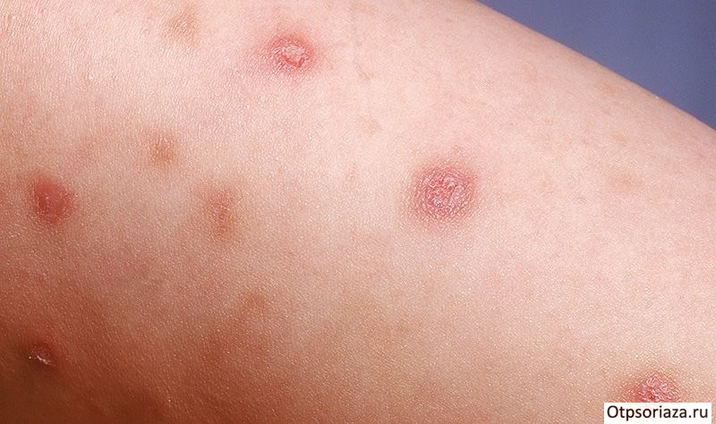 Начальная стадия псориаза Начальная стадия псориаза