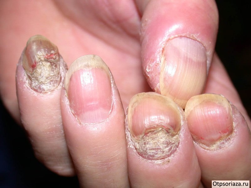 Ногтевой псориаз Ногтевой псориаз
