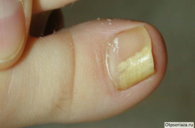 Онихолизис Онихолизис