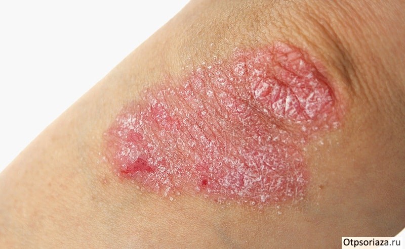 Прогрессирующая форма псориаза Прогрессирующая форма псориаза