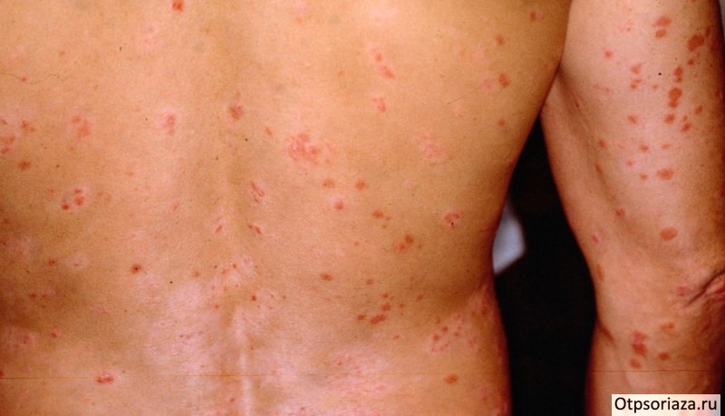 Псориатическая эритродермия Псориатическая эритродермия