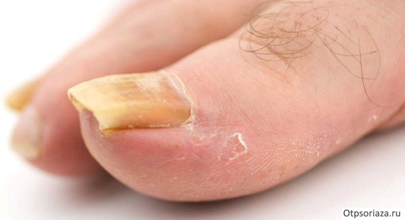 Псориатическая паронихия Псориатическая паронихия