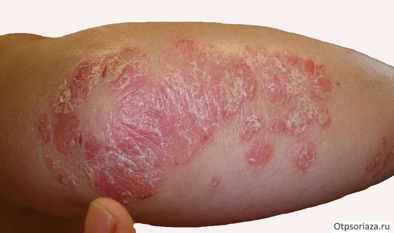 Псориаз на локте Псориаз на локте