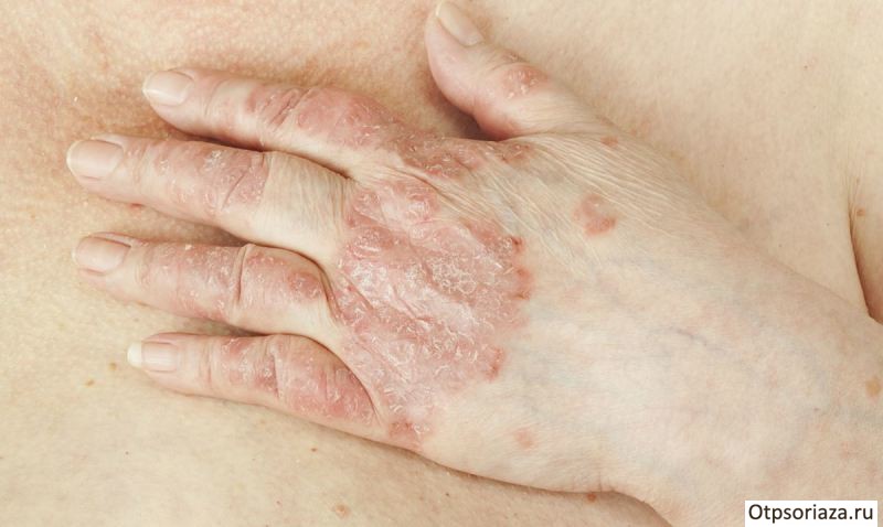 Псориаз на руке Псориаз на руке