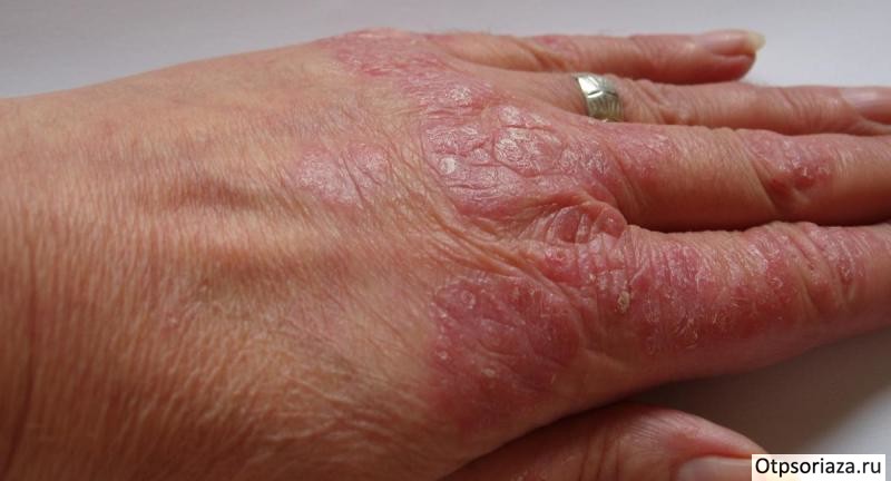 Псориаз на руке Псориаз на руке