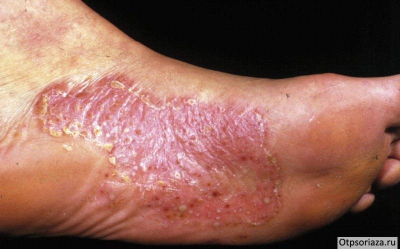 Псориаз на ступне Псориаз на ступне