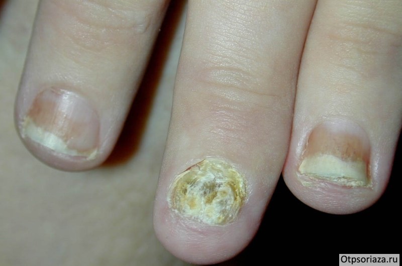 Псориаз ногтей Псориаз ногтей