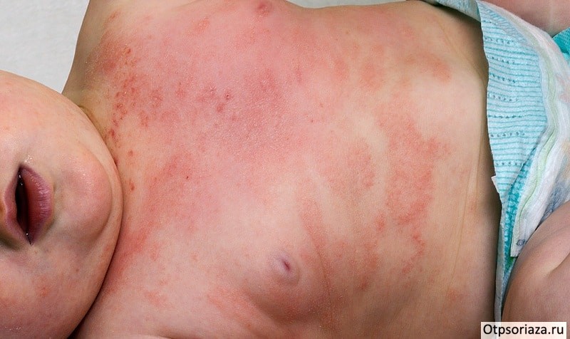 Псориаз у ребенка Псориаз у ребенка