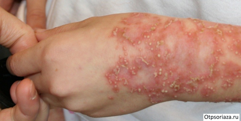 Пустулезный псориаз Пустулезный псориаз