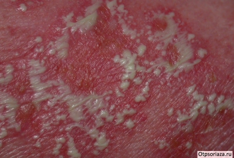Пустулёзная форма псориаза Пустулёзный псориаз