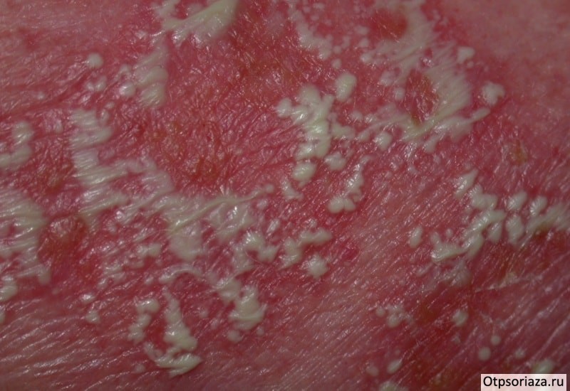 Пустулёзный псориаз Пустулёзный псориаз