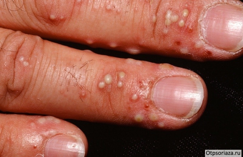 Пустулёзный тип псориаза Пустулёзный тип псориаза