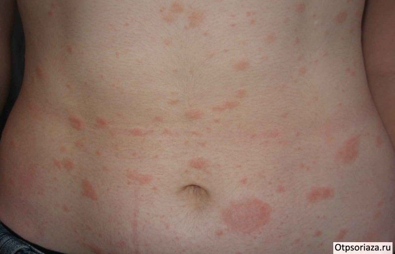 Регрессирующая форма псориаза Регрессирующая стадия псориаза