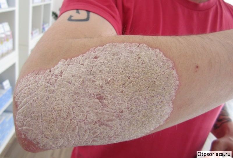 Стационарная форма псориаза Стационарная форма псориаза