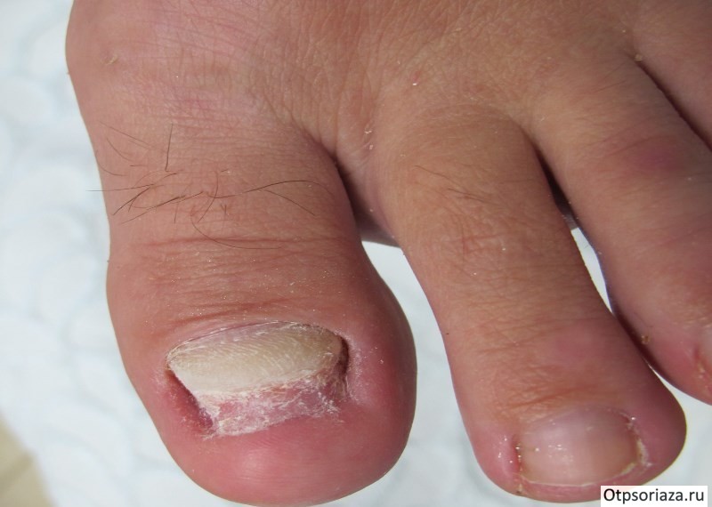 Трахионихия Трахионихия