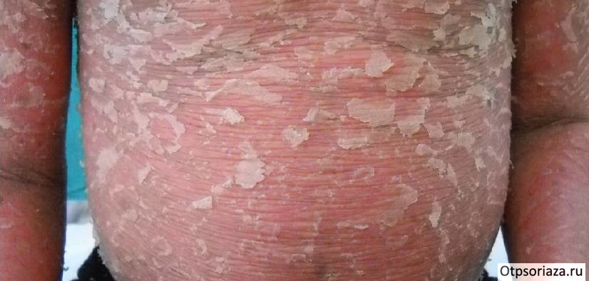 Эритродермический псориаз Псориаз эритродермический