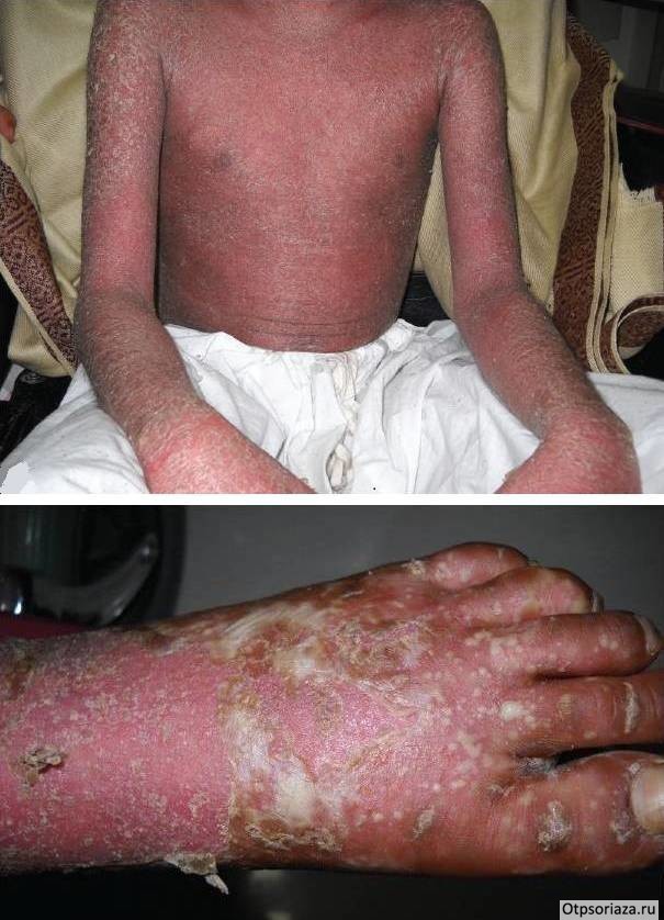 Генерализованный пустулезный псориаз Детский генерализованный пустулезный псор