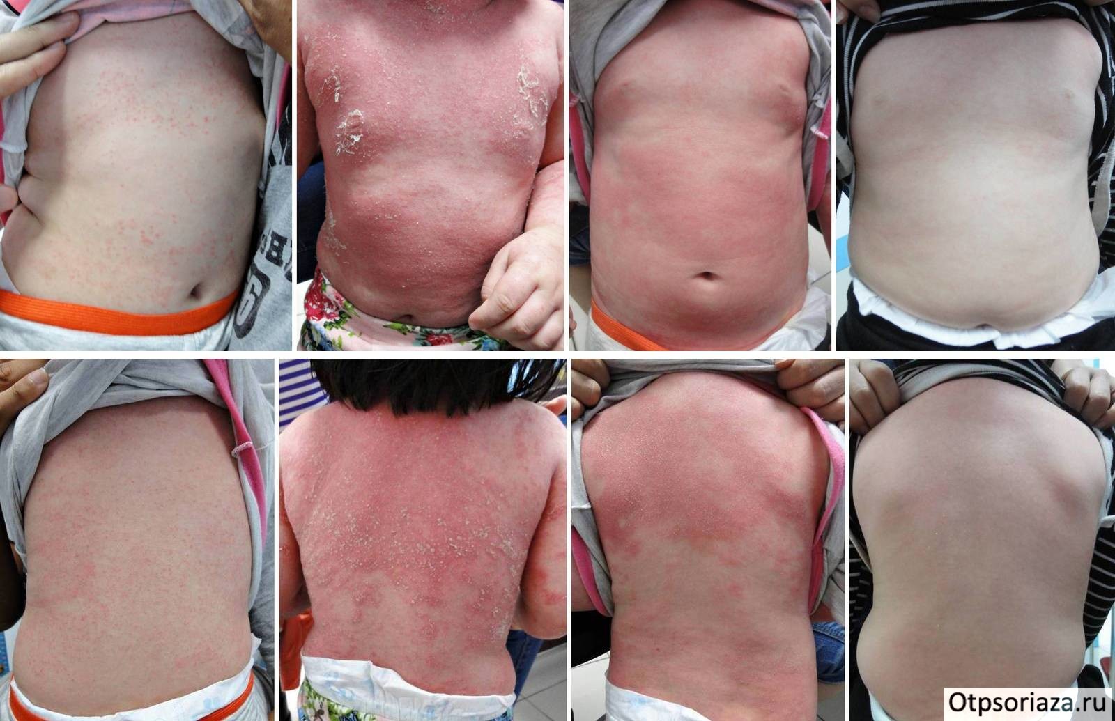 Лечение псориаза у детей Лечение детского псориаза