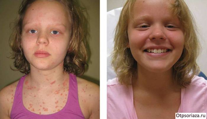 Лечение псориаза у детей Девочка после лечения псориаза