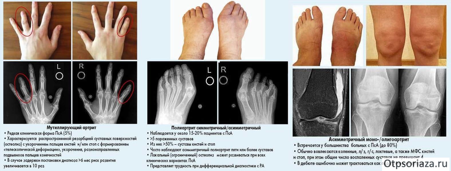 Псориатический артрит Разновидности ПсА