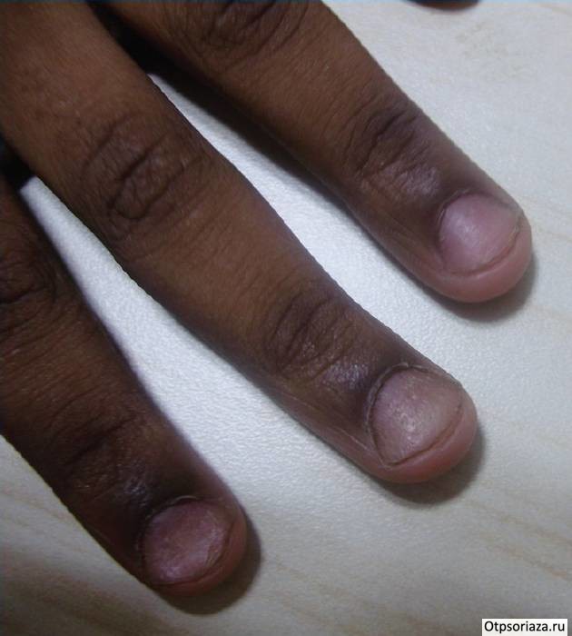 Псориаз ногтей Псориаз ногтей