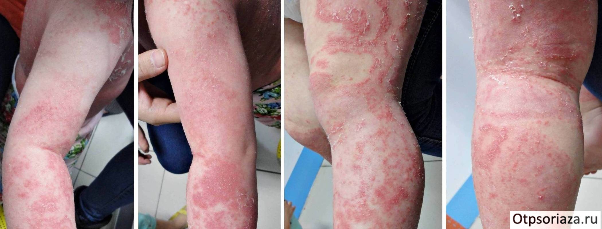 Псориаз сгибательных поверхностей Псориаз на локтях и коленях у детей