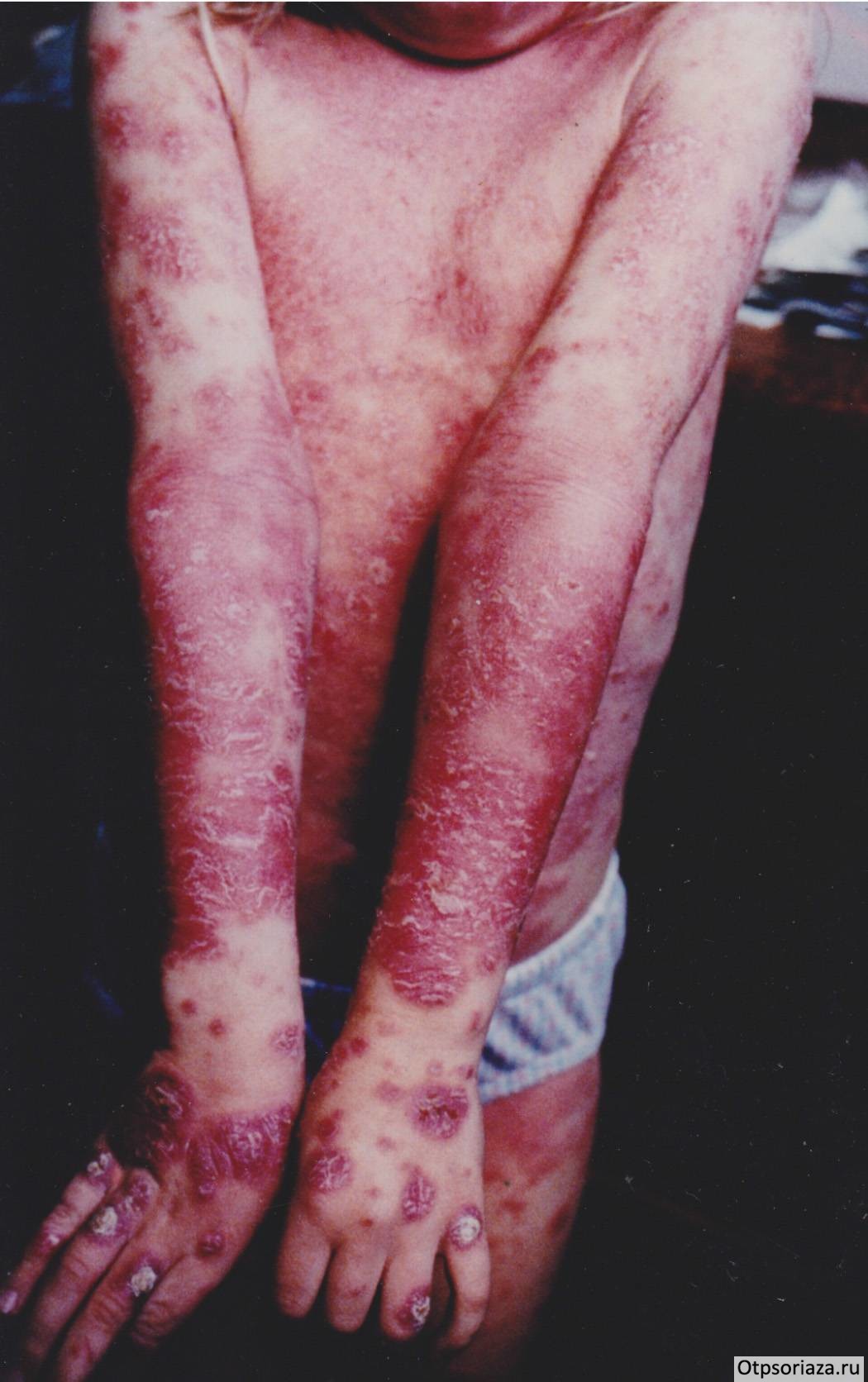 Пустулезный псориаз Детский пустулезный псор