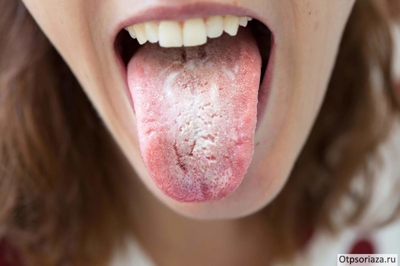 кандидоз во рту Кандидоз