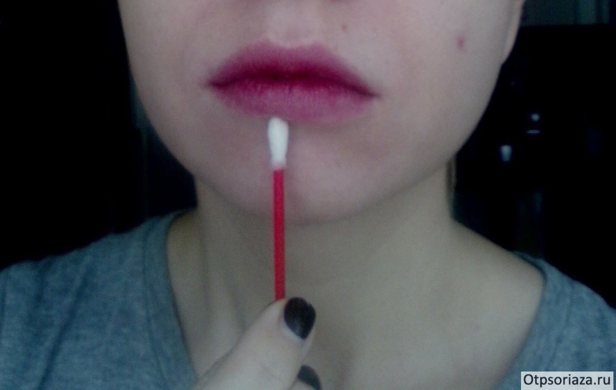 Наносится мазь ватной палочкой Нанесение мази от псориаза ватной палочкой