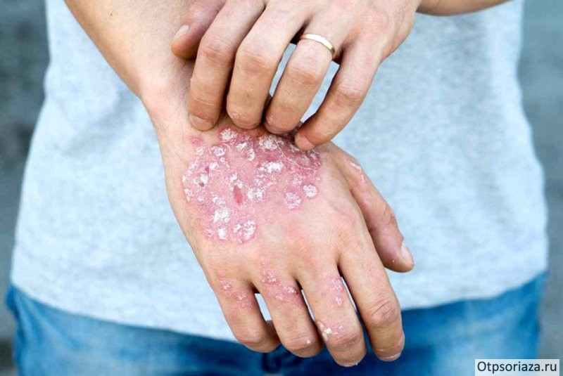 отечность Отёчность