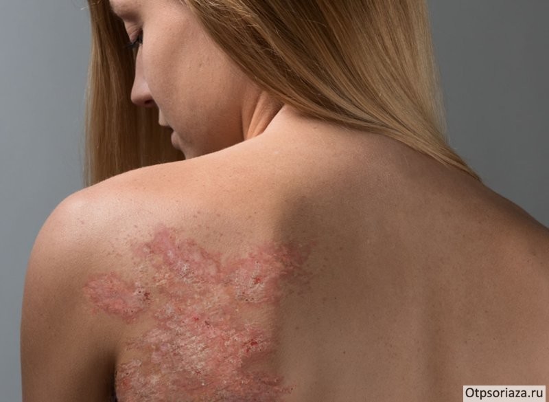 псориаз Псориаз