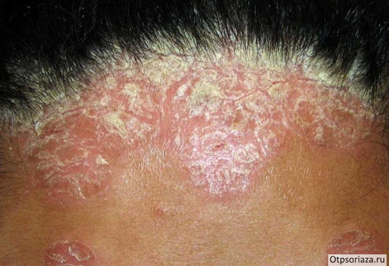 псориаз Псориаз