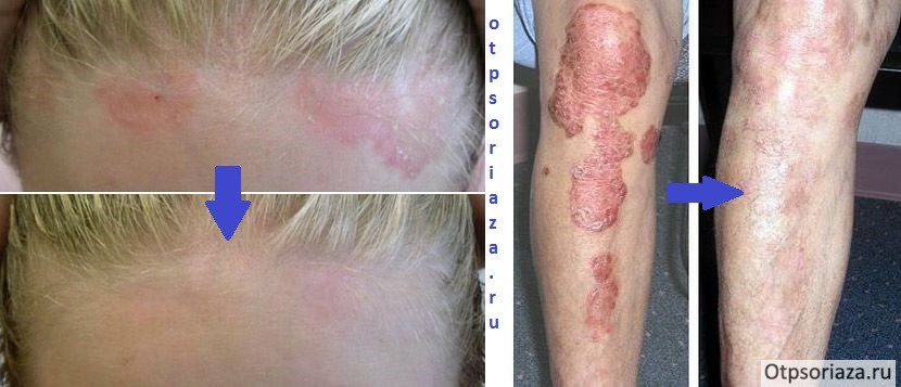 Псориаз до и после лечения Лечение псориаза салициловой мазью - результат