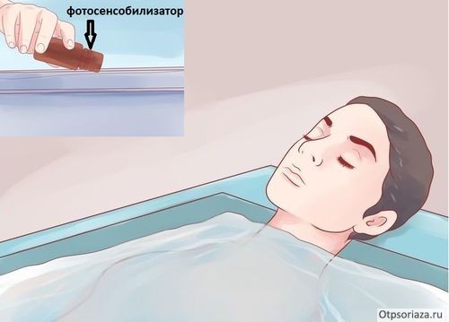 Фотосенсибилизатор растворяют в воде в ванной Ванные с фотосенсибилизатором при ПУВА-терапии псориаза.
