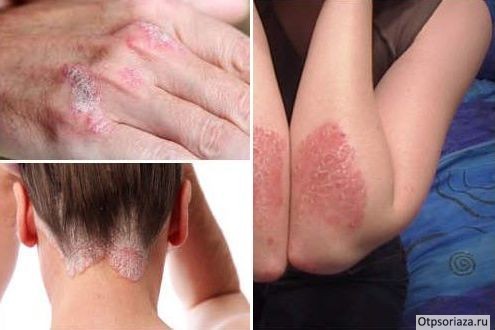 Симптомы псориаза Первые симптомы псориаза