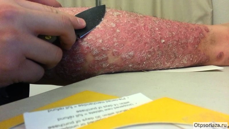 соскоб Соскоб