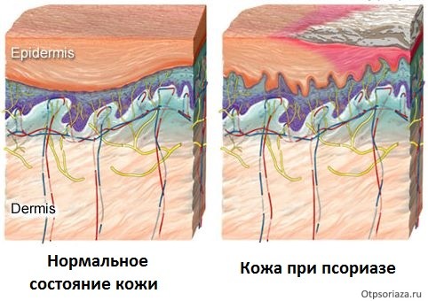 Состояние обычной кожи и кожи при псориазе