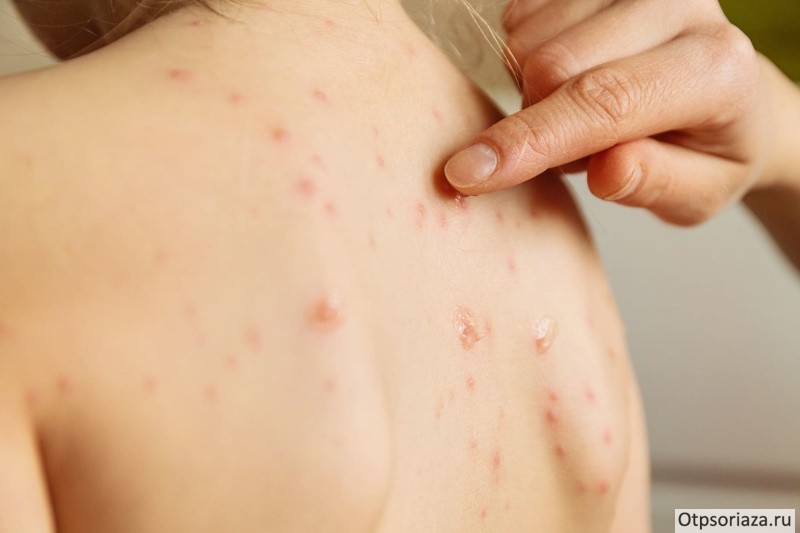 ветрянка Ветрянка