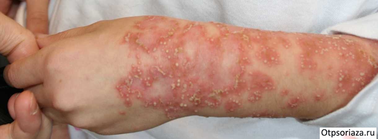 Псориаз Цумбуша zumbusch psoriasis