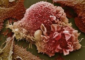 Аденокарцинома Аденокарцинома