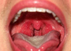 1 Симптомы стрептококковой инфекции